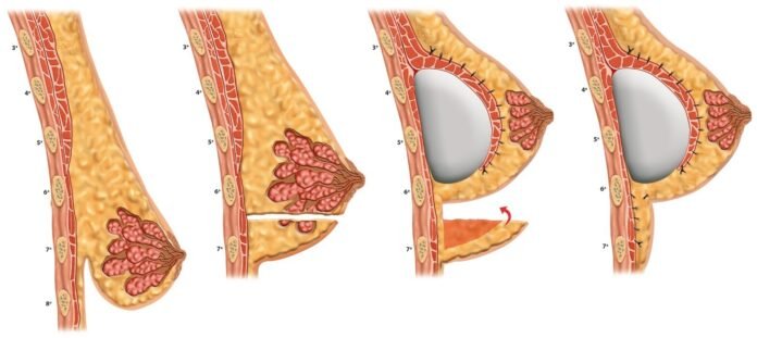Técnica brasileira de mastopexia é sistematizada Técnica brasileira de mastopexia é sistematizada